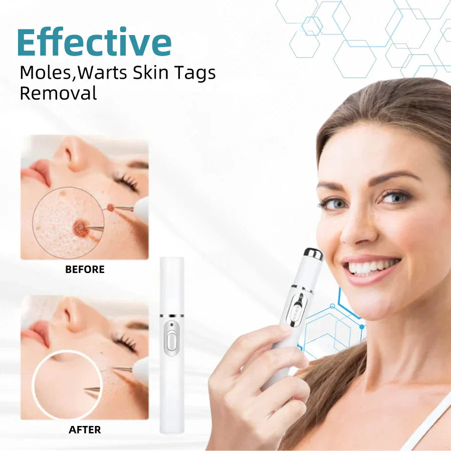 Bikenda® VelvetSkin+ Medical-Grade Laser Pen (Powered by CO₂ laser technology – effectively removes moles, warts, skin tags, pigmentation spots, and other skin imperfections)
