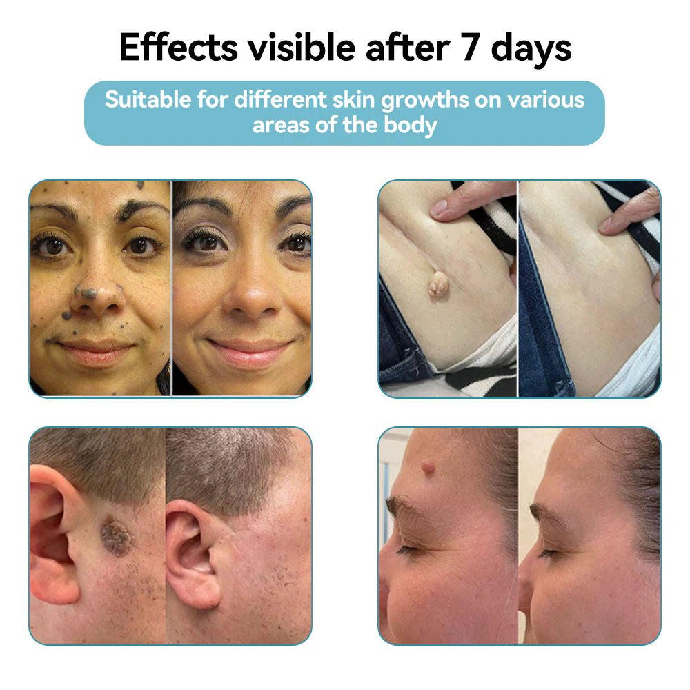 Bikenda® VelvetSkin+ Medical-Grade Laser Pen (Powered by CO₂ laser technology – effectively removes moles, warts, skin tags, pigmentation spots, and other skin imperfections)