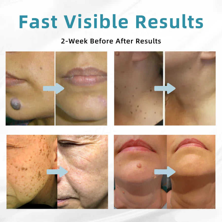 Bikenda® VelvetSkin+ Medical-Grade Laser Pen (Powered by CO₂ laser technology – effectively removes moles, warts, skin tags, pigmentation spots, and other skin imperfections)