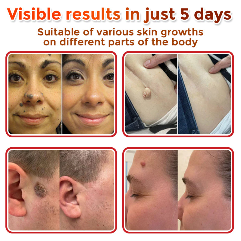 GFOUK® MicroNeedle Botanic Skin Tag Removal Patch 🇺🇸 Made in the USA
