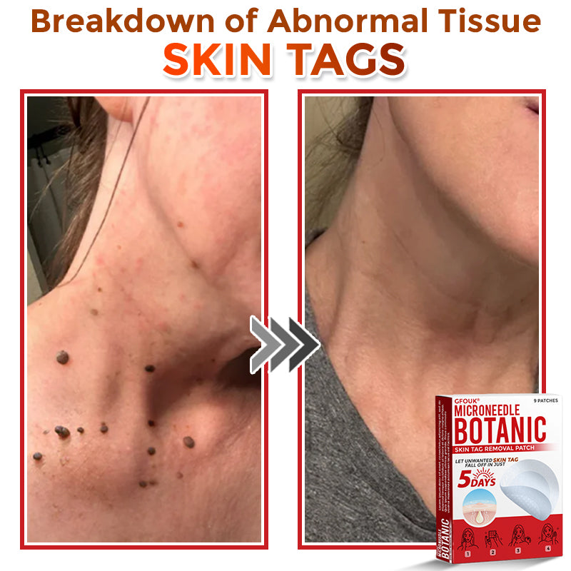 GFOUK® MicroNeedle Botanic Skin Tag Removal Patch 🇺🇸 Made in the USA