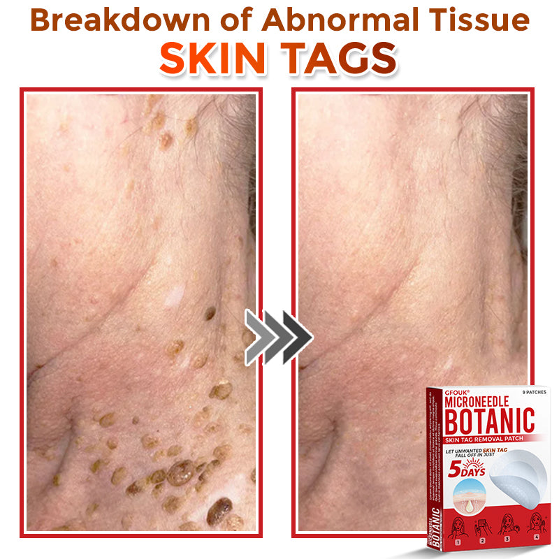 GFOUK® MicroNeedle Botanic Skin Tag Removal Patch 🇺🇸 Made in the USA