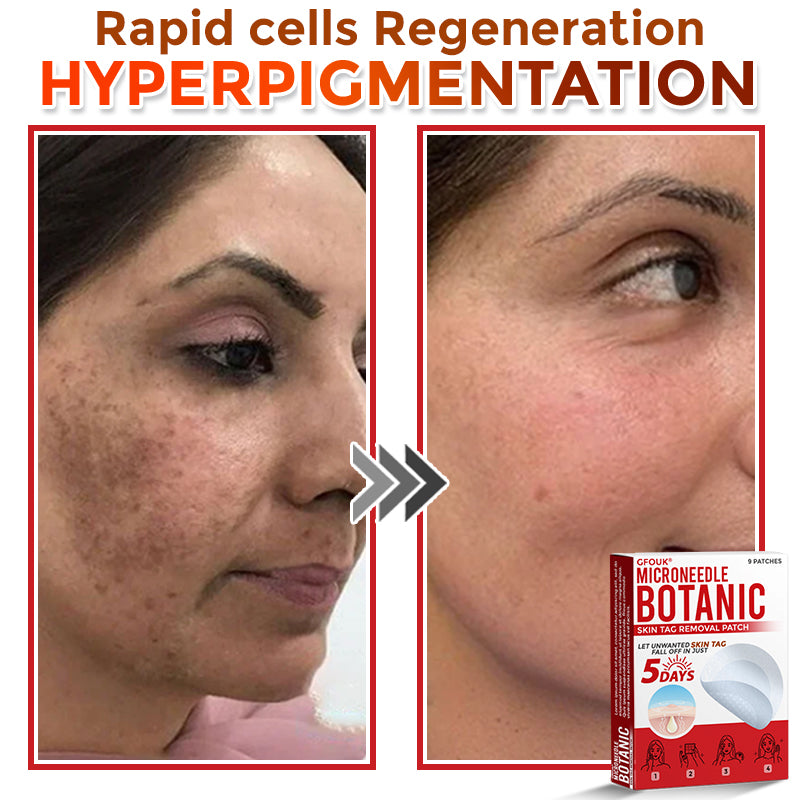 GFOUK® MicroNeedle Botanic Skin Tag Removal Patch 🇺🇸 Made in the USA