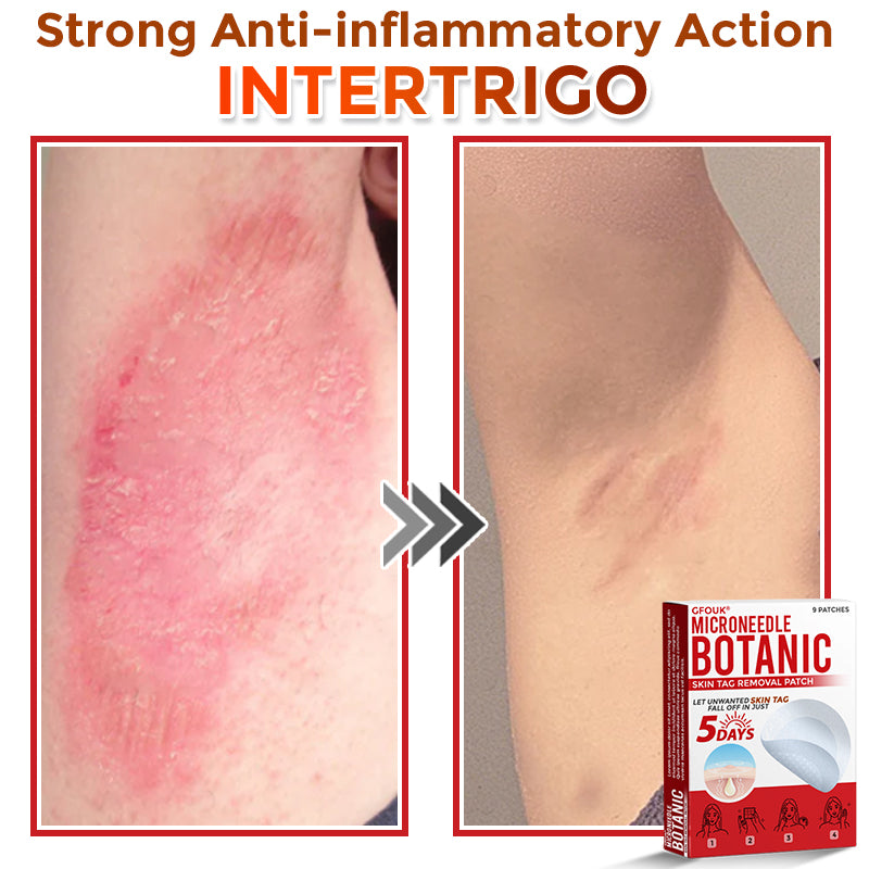 GFOUK® MicroNeedle Botanic Skin Tag Removal Patch 🇺🇸 Made in the USA