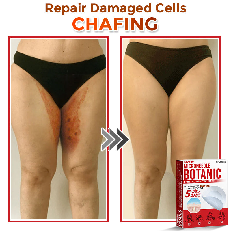 GFOUK® MicroNeedle Botanic Skin Tag Removal Patch 🇺🇸 Made in the USA