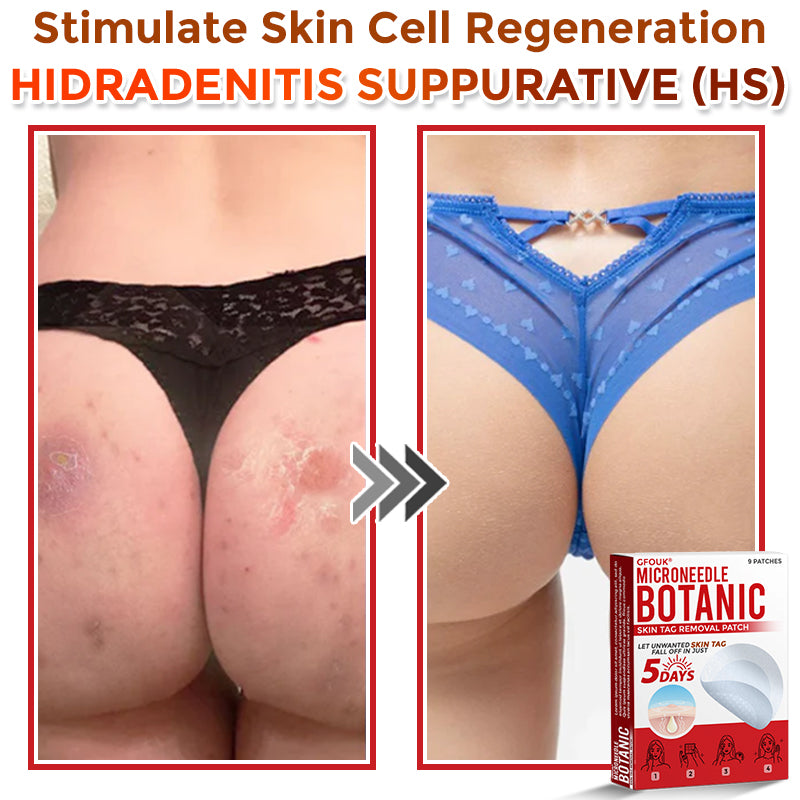 GFOUK® MicroNeedle Botanic Skin Tag Removal Patch 🇺🇸 Made in the USA