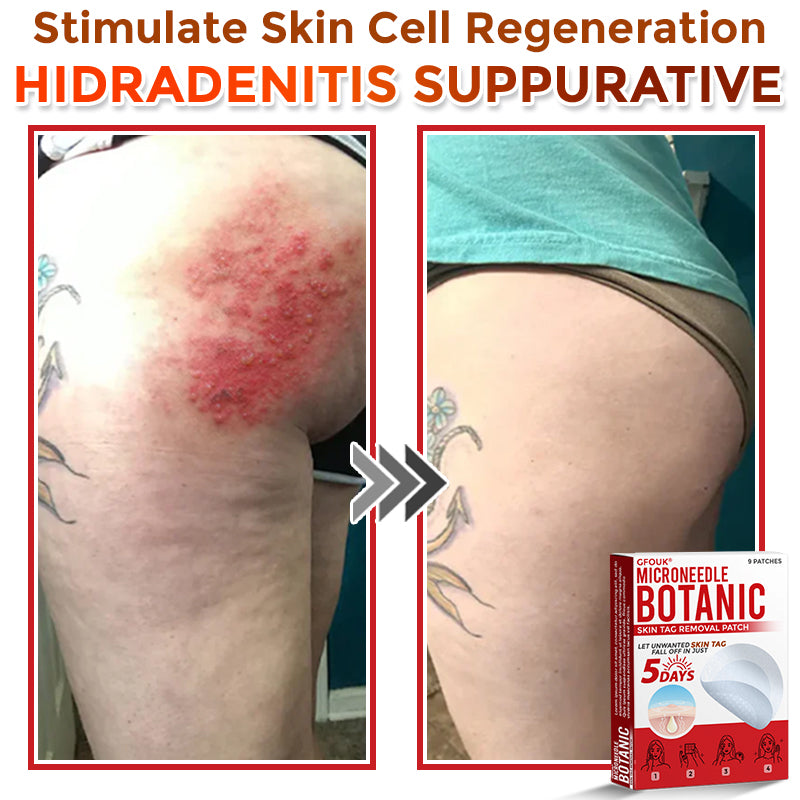GFOUK® MicroNeedle Botanic Skin Tag Removal Patch 🇺🇸 Made in the USA