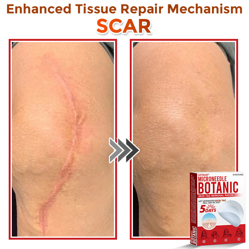 GFOUK® MicroNeedle Botanic Skin Tag Removal Patch 🇺🇸 Made in the USA