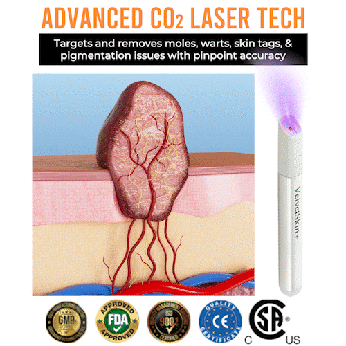 Bikenda® VelvetSkin+ Medical-Grade Laser Pen (Powered by CO₂ laser technology – effectively removes moles, warts, skin tags, pigmentation spots, and other skin imperfections)