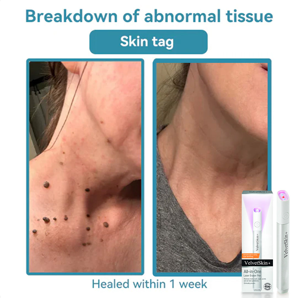 Bikenda® VelvetSkin+ Medical-Grade Laser Pen (Powered by CO₂ laser technology – effectively removes moles, warts, skin tags, pigmentation spots, and other skin imperfections)