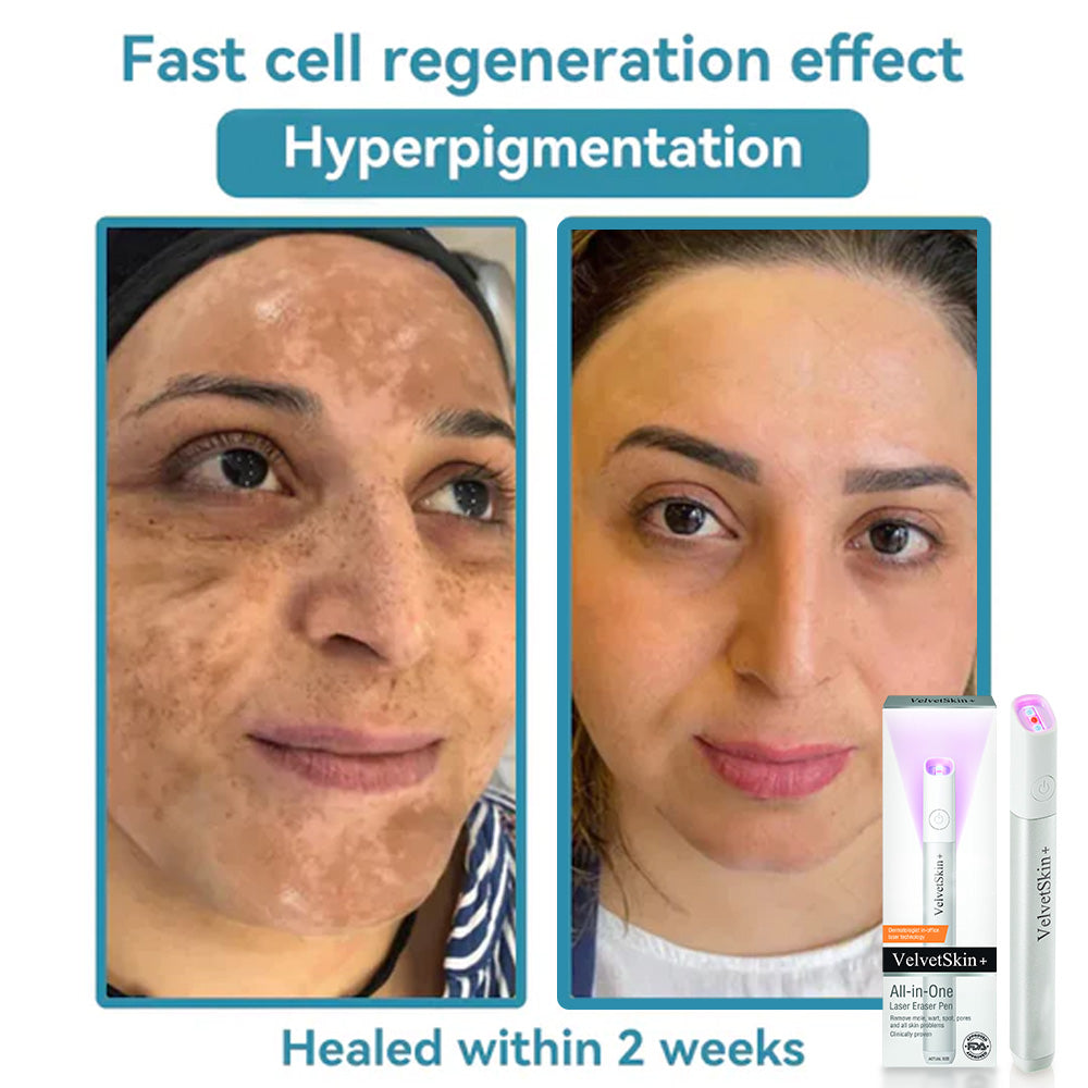 Bikenda® VelvetSkin+ Medical-Grade Laser Pen (Powered by CO₂ laser technology – effectively removes moles, warts, skin tags, pigmentation spots, and other skin imperfections)