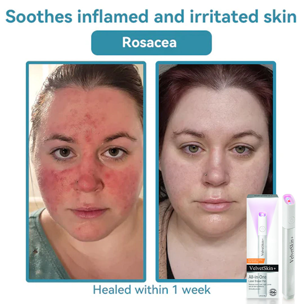 Bikenda® VelvetSkin+ Medical-Grade Laser Pen (Powered by CO₂ laser technology – effectively removes moles, warts, skin tags, pigmentation spots, and other skin imperfections)