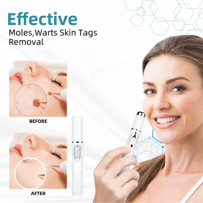Bikenda® VelvetSkin+ Medical-Grade Laser Pen (Powered by CO₂ laser technology – effectively removes moles, warts, skin tags, pigmentation spots, and other skin imperfections)