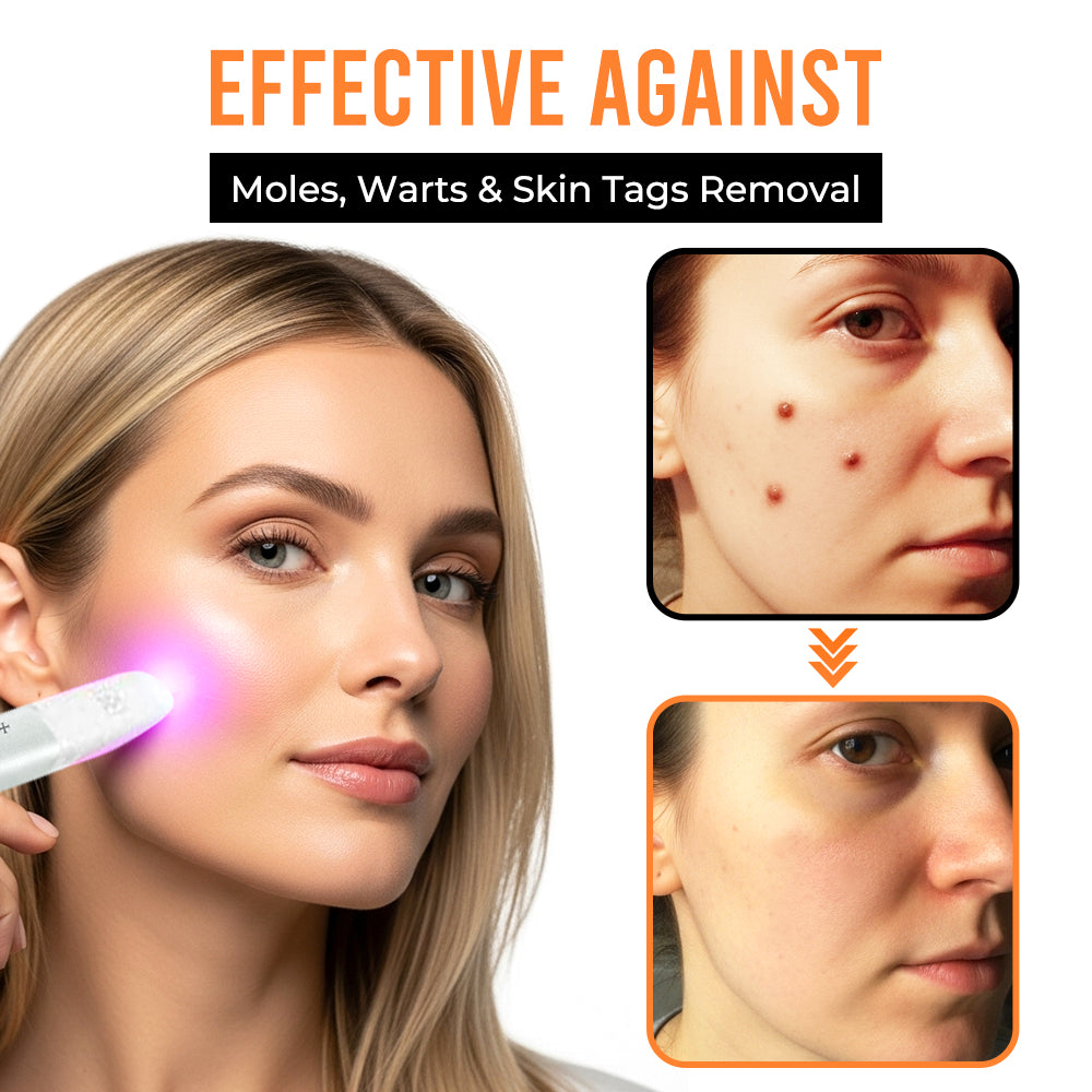 Remifa® VelvetSkin+ All-in-One Laser Eraser Pen (Powered by CO₂ laser technology – ef fectively removes moles, warts, skin tags, pigmentation spots, and other skin imperfections)