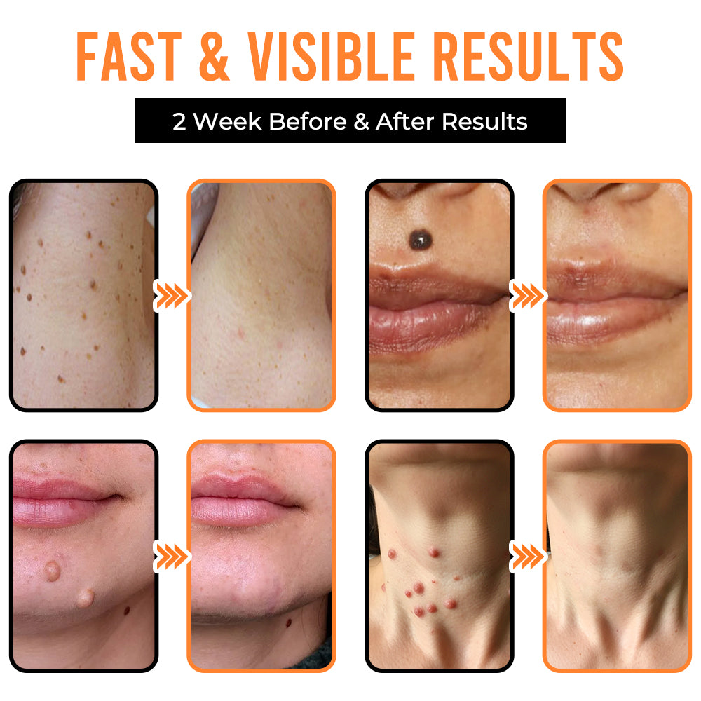 Remifa® VelvetSkin+ All-in-One Laser Eraser Pen (Powered by CO₂ laser technology – ef fectively removes moles, warts, skin tags, pigmentation spots, and other skin imperfections)