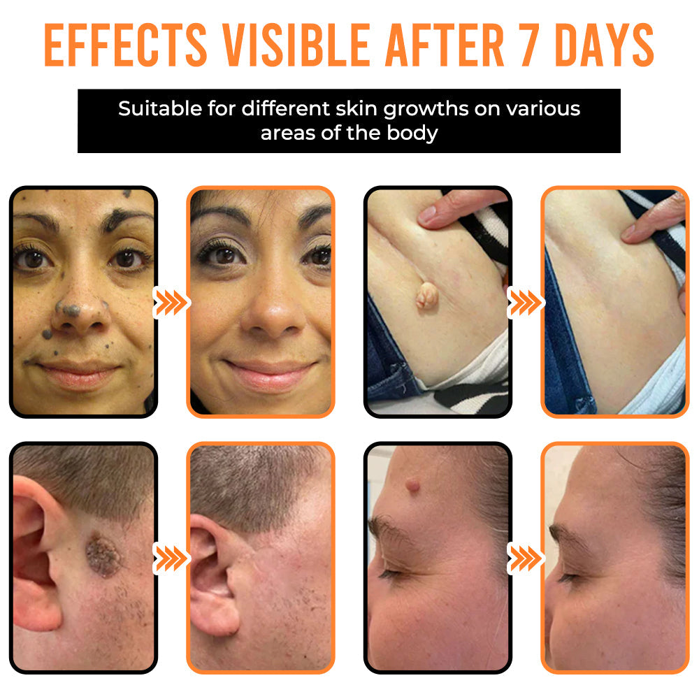 Remifa® VelvetSkin+ All-in-One Laser Eraser Pen (Powered by CO₂ laser technology – ef fectively removes moles, warts, skin tags, pigmentation spots, and other skin imperfections)
