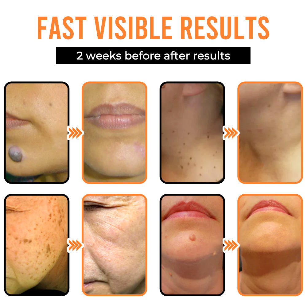 Remifa® VelvetSkin+ All-in-One Laser Eraser Pen (Powered by CO₂ laser technology – ef fectively removes moles, warts, skin tags, pigmentation spots, and other skin imperfections)