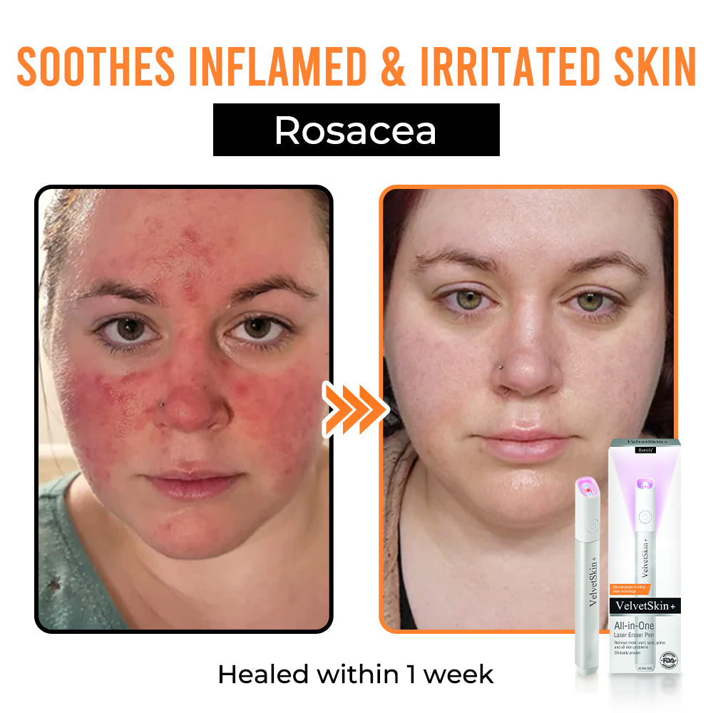 Remifa® VelvetSkin+ All-in-One Laser Eraser Pen (Powered by CO₂ laser technology – ef fectively removes moles, warts, skin tags, pigmentation spots, and other skin imperfections)