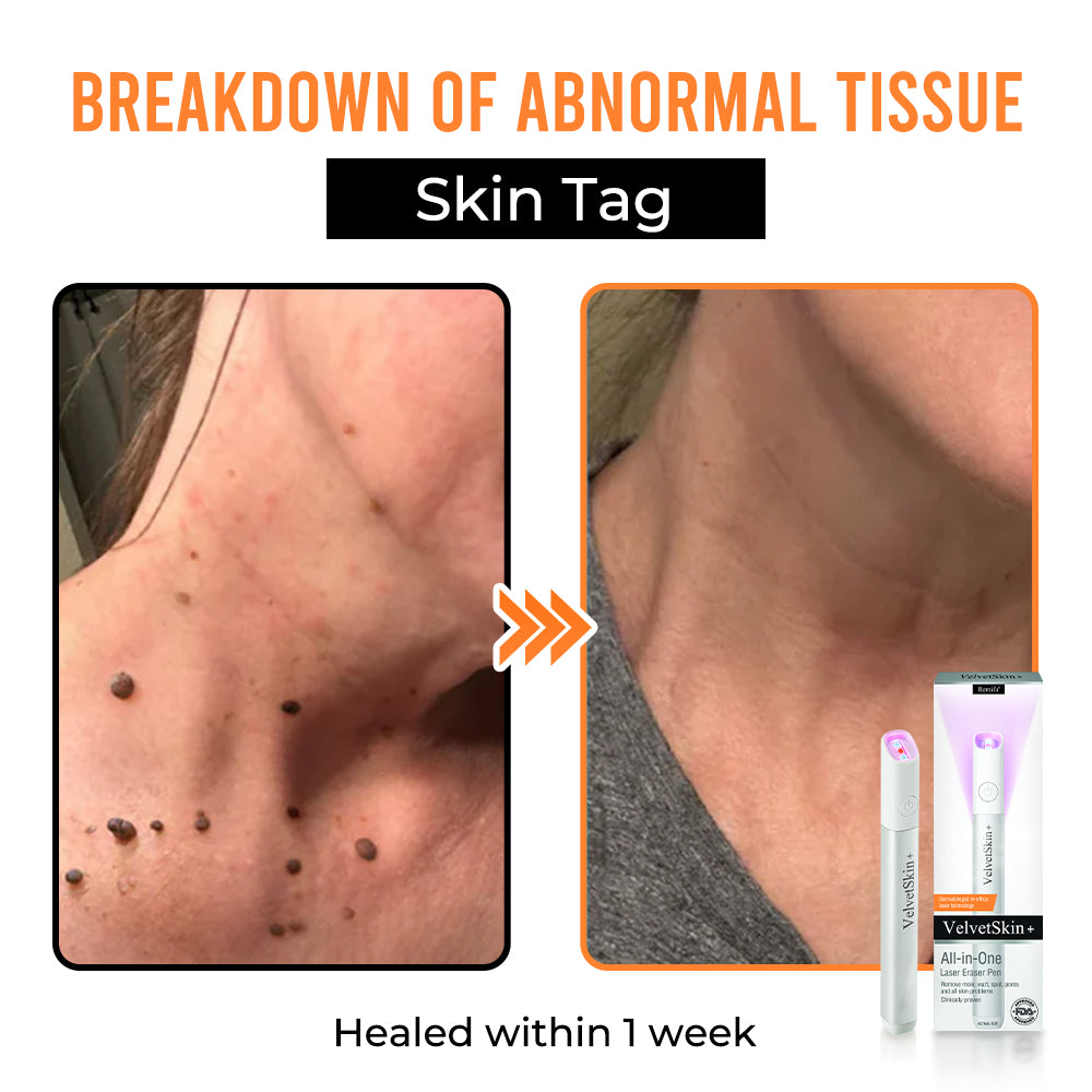 Remifa® VelvetSkin+ All-in-One Laser Eraser Pen (Powered by CO₂ laser technology – ef fectively removes moles, warts, skin tags, pigmentation spots, and other skin imperfections)