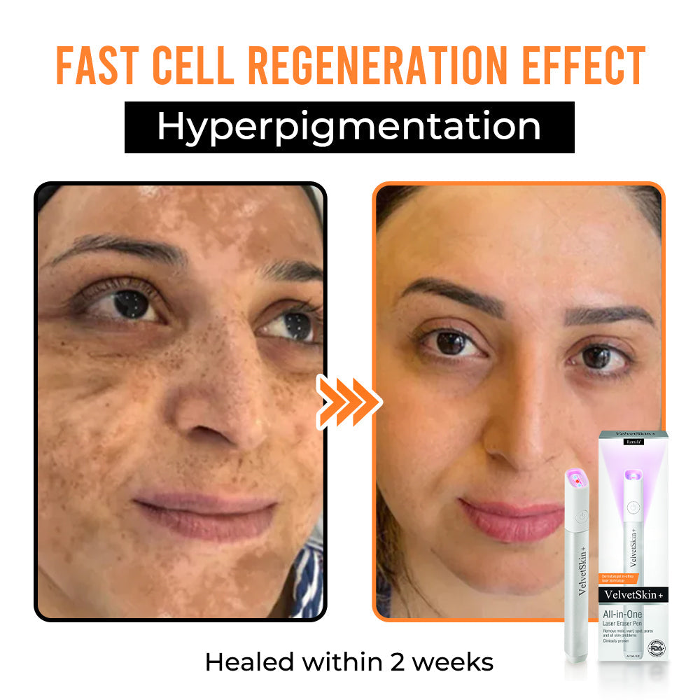 Remifa® VelvetSkin+ All-in-One Laser Eraser Pen (Powered by CO₂ laser technology – ef fectively removes moles, warts, skin tags, pigmentation spots, and other skin imperfections)