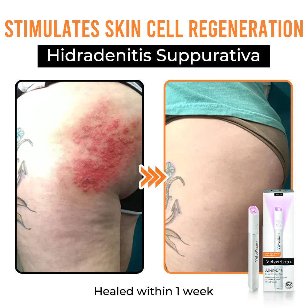 Remifa® VelvetSkin+ All-in-One Laser Eraser Pen (Powered by CO₂ laser technology – ef fectively removes moles, warts, skin tags, pigmentation spots, and other skin imperfections)
