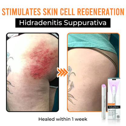 Remifa® VelvetSkin+ All-in-One Laser Eraser Pen (Powered by CO₂ laser technology – ef fectively removes moles, warts, skin tags, pigmentation spots, and other skin imperfections)