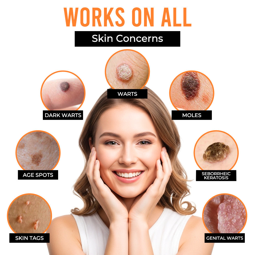 Remifa® VelvetSkin+ All-in-One Laser Eraser Pen (Powered by CO₂ laser technology – ef fectively removes moles, warts, skin tags, pigmentation spots, and other skin imperfections)