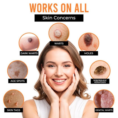 Remifa® VelvetSkin+ All-in-One Laser Eraser Pen (Powered by CO₂ laser technology – ef fectively removes moles, warts, skin tags, pigmentation spots, and other skin imperfections)