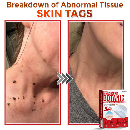 🔥🌻GFOUK® MicroNeedle Botanic Skin Tag Removal Patch 🇺🇸 Made in the USA