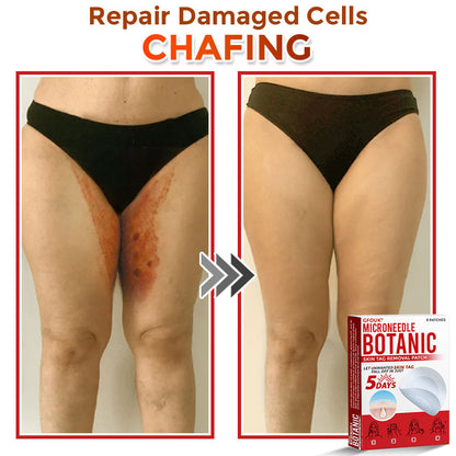 🔥🌻GFOUK® MicroNeedle Botanic Skin Tag Removal Patch 🇺🇸 Made in the USA