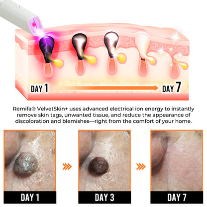 Remifa® VelvetSkin+ All-in-One Laser Eraser Pen (Powered by CO₂ laser technology – ef fectively removes moles, warts, skin tags, pigmentation spots, and other skin imperfections)